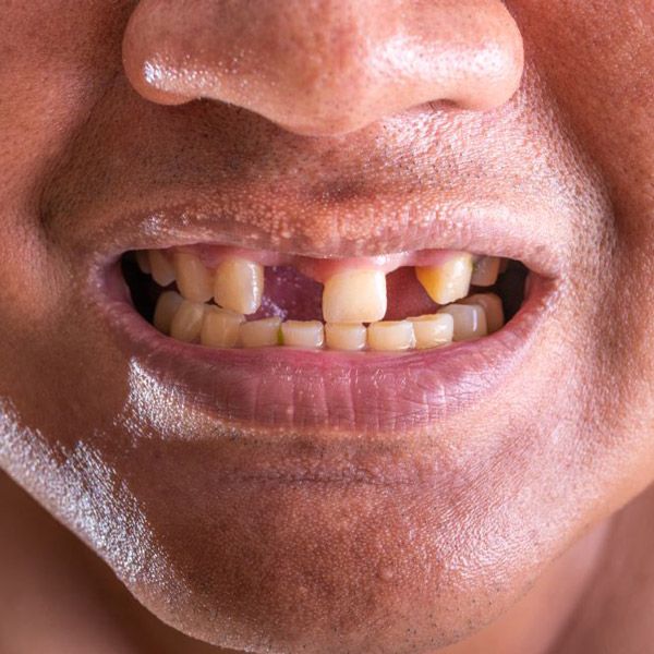 Man with multiple missing teeth