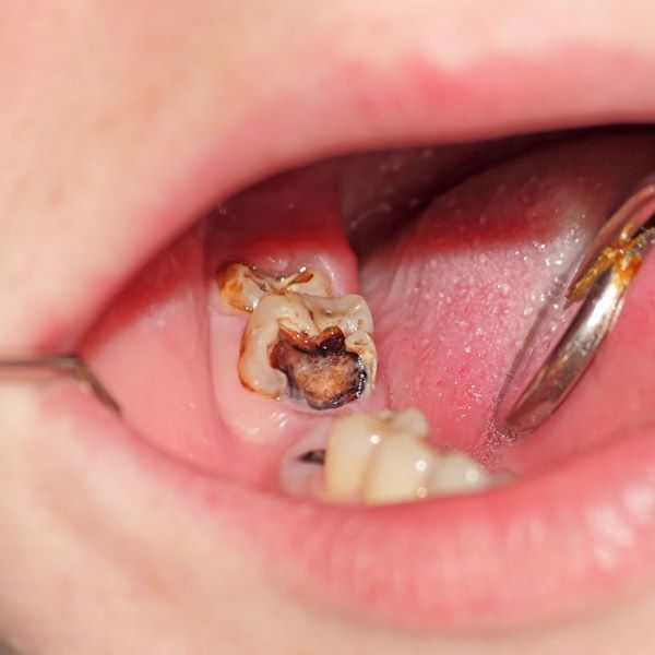 Badly decayed tooth