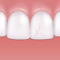 Cracked tooth