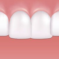 Crowded teeth