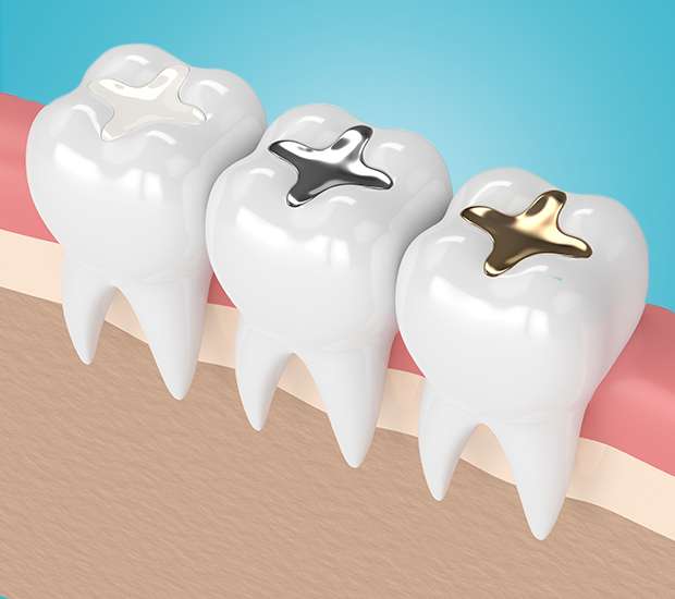Stockbridge Composite Fillings