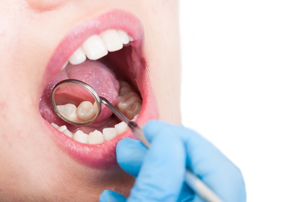 How Long Do Dental Fillings Last?