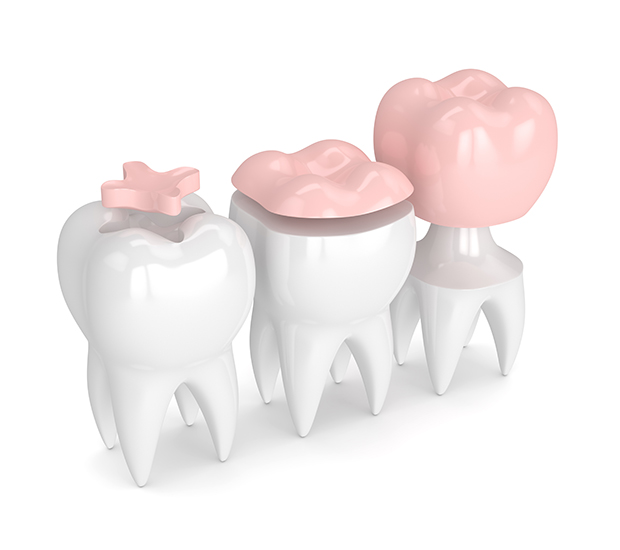 Stockbridge Dental Inlays and Onlays