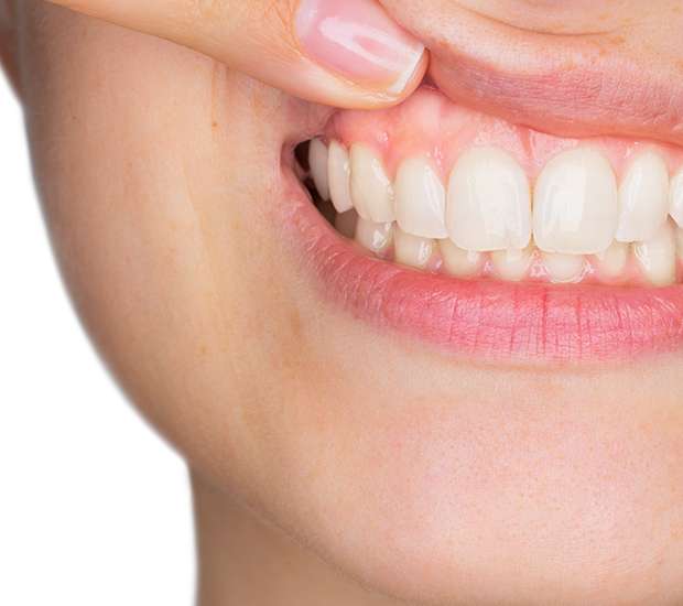 Stockbridge Gum Disease