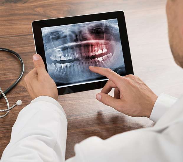 Stockbridge Types of Dental Root Fractures