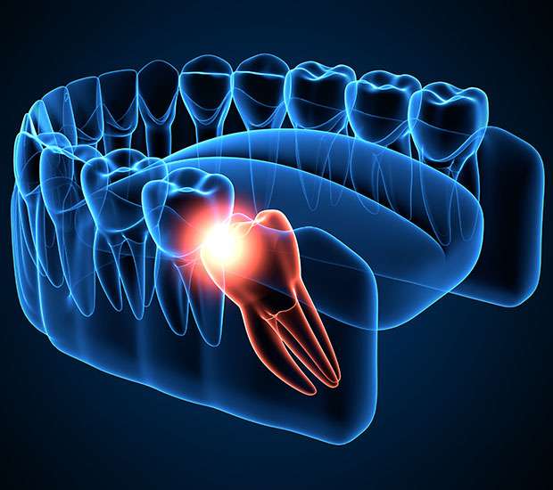 Stockbridge Wisdom Teeth Extraction